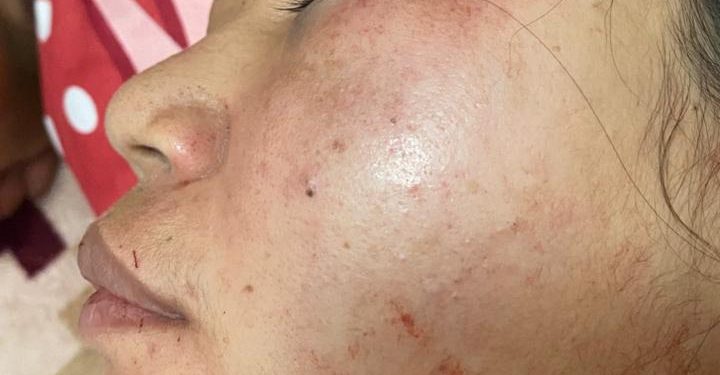 Sadis!! Dua Tenaga Kesehatan Puskesmas Embo Jadi Korban Penjambret, Polisi Sebut Keduanya Mengalami Luka